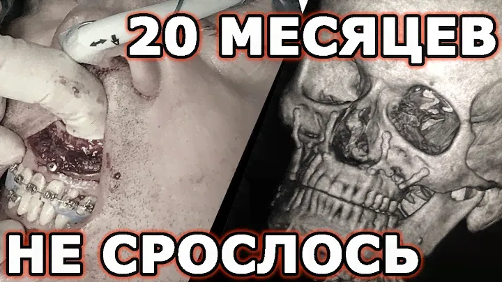 В суд на хирурга? Ортогнатическая операция. 20 мес. спустя.